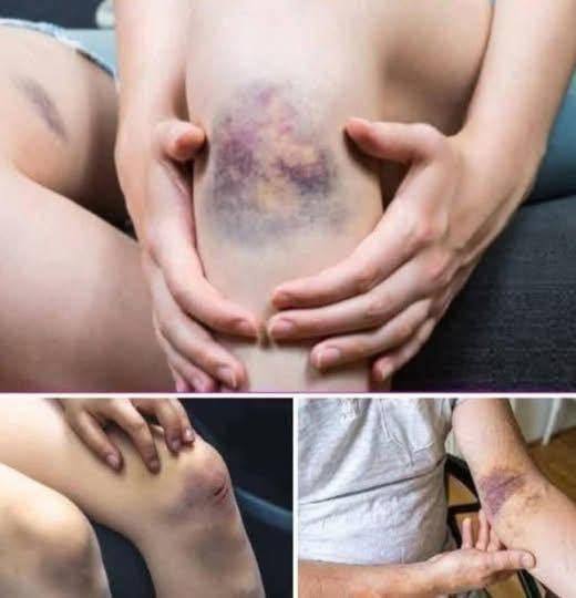 BE CAREFUL, if you get these bruises on your body, it means you have Ca…see more