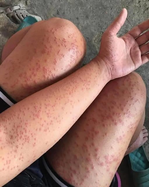 I Slept in My Friends Old Apartment and My Skin Tried to Warn Me