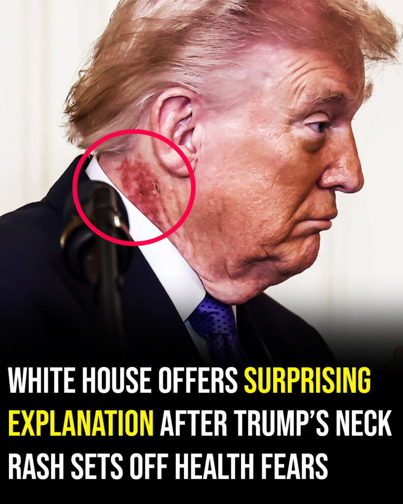 Scabbing neck rash fuels new health speculation around Donald Trump