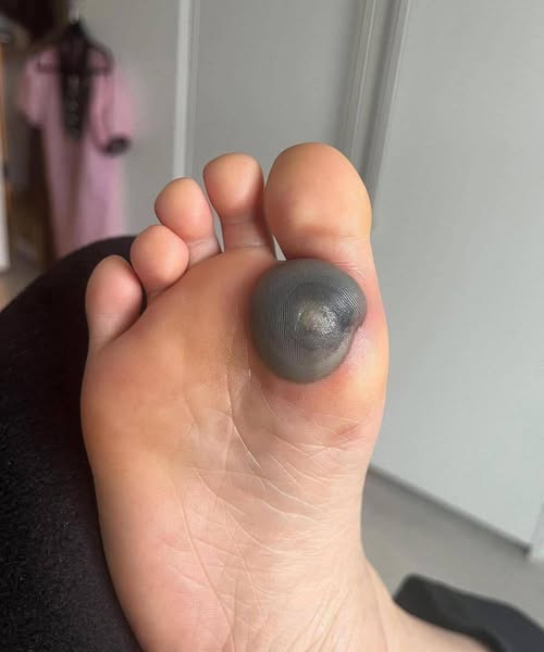 A Painful Dark Spot on the Foot: When to Worry