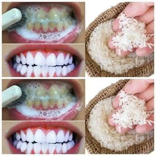 The Hidden Dangers of Viral Rice-Based Teeth Whitening Trends and Why Your Enamel Matters
