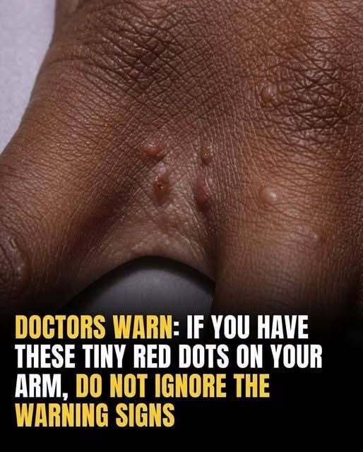 Is That Itchy Rash on Your Hands Actually a Hidden Danger? The Secret Signs of Dyshidrotic Eczema You Can’t Afford to Ignore