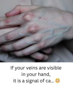 If your veins are visible in your hand, it is a signal about your liver health