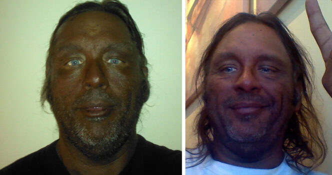 Man who used Melanotan II injections for 20 years shares his warning