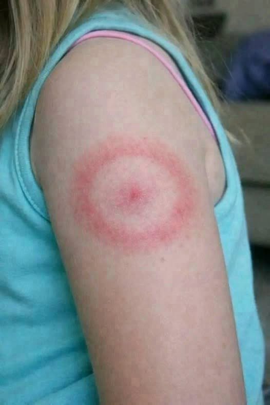 Assessing Circular Rashes in Children: A Calm Approach to Monitoring and Understanding Skin Changes