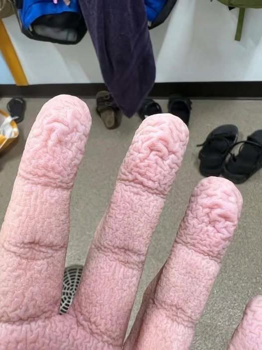 Understanding Why Fingers Wrinkle in Water and When to Seek Professional Medical Advice