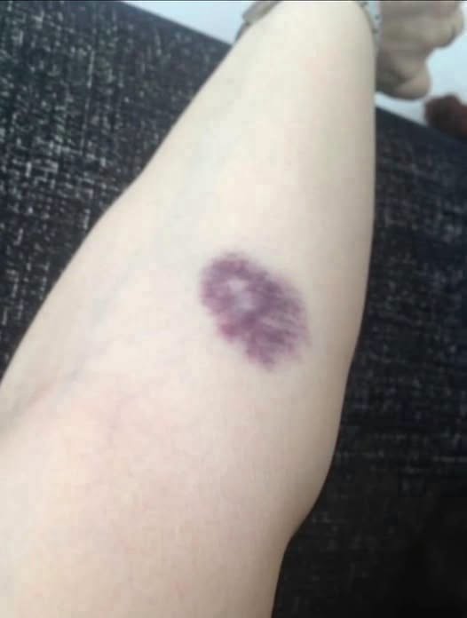 Understanding Unexplained Bruising and When to Seek Professional Medical Guidance for Your Health Concerns