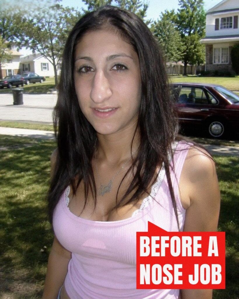 I Got a Nose Job After Years of Being Bullied – When I Came Home, My Husband Had Removed Every Mirror
